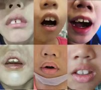 ��ͯ������ʴ���˯�߼����ҪסԺ��